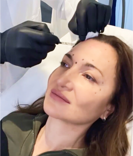 botox_3