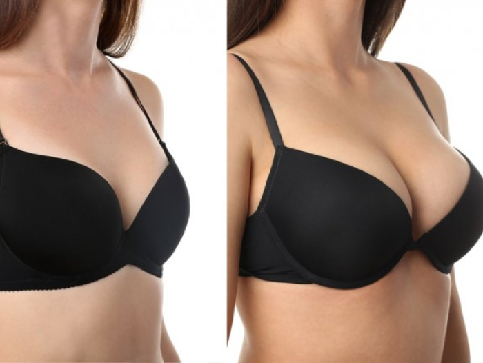 Augmentation mammaire par implants